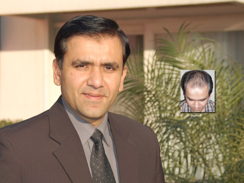 FUE Hair Transplant Results in Pakistan: Hamid